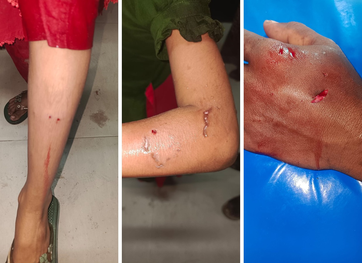 বরুড়ায় পাগলা কুকুরের কামড়ে অন্তত ২০ জন আহত