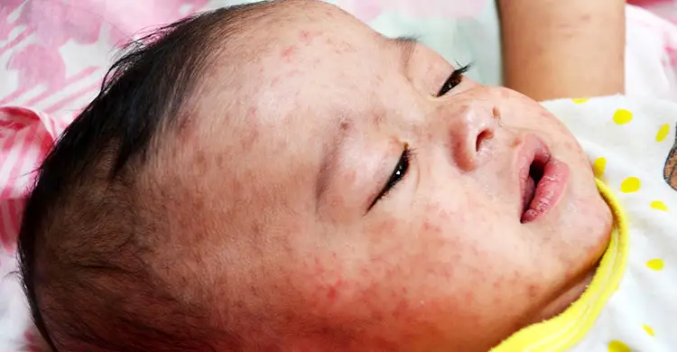 হাম প্রাদুর্ভাব নিয়ে কিছু কথা